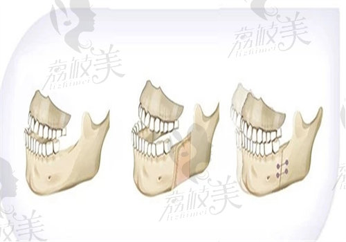 偏頜哪個(gè)醫(yī)生做的好一點(diǎn)