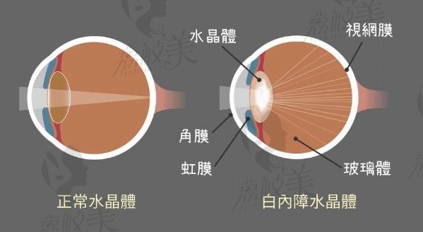 白内障手术费用60岁老人免费吗？