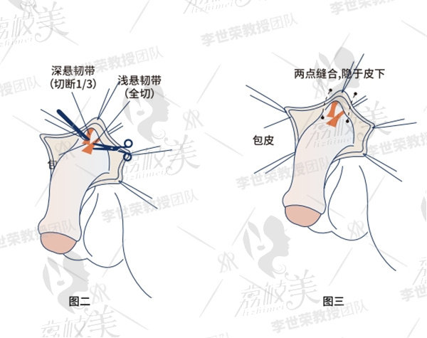 李世荣做延长术效 果