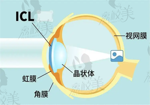 icl晶体植入术后光圈多久消失？