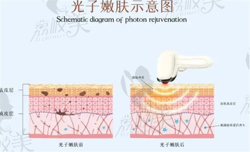 水光針和光子嫩肤的区别