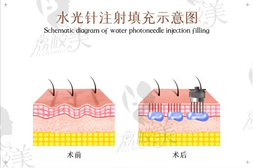 水光針和光子嫩肤的区别