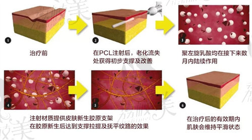 少女针和童颜针的作用和成效