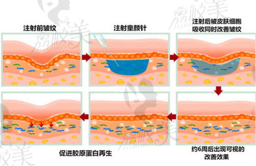 少女针和童颜针的作用和成效