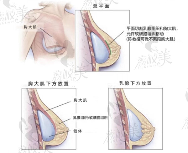 什么是双平面隆胸技术