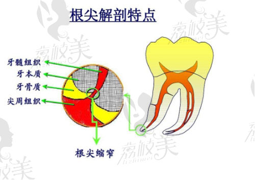 后磨牙根管治療有什么要注意的