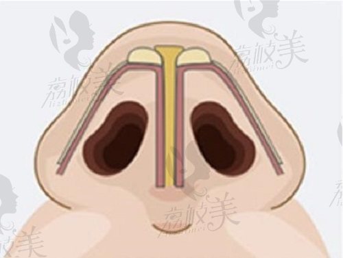 鄧東偉和段燾醫(yī)生的隆鼻手術(shù)價(jià)格