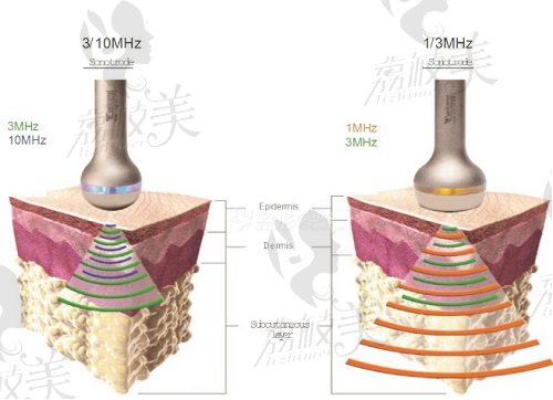 LDM水滴提升多少钱一次