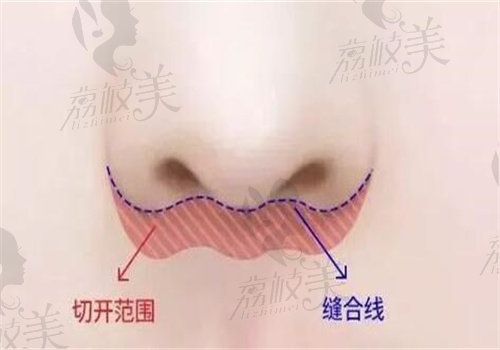 深圳胡俊杰做唇部整形價格