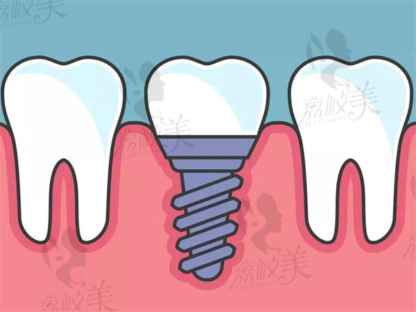 即刻负重和普通种植牙的区别