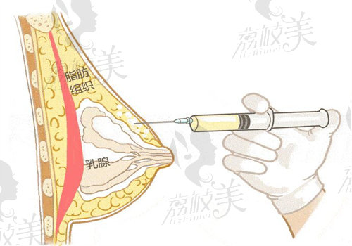 李营整形医生做乳房下垂技术可靠