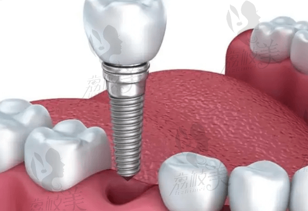 杭州植成口腔医院种植牙怎么样