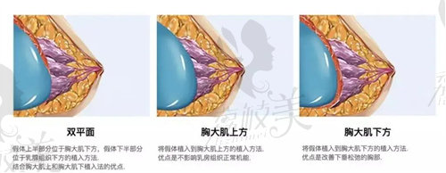 重庆铜雀台隆胸医生技术对比