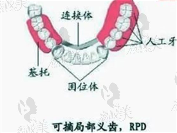 无挂钩假牙和种植牙的区别在哪