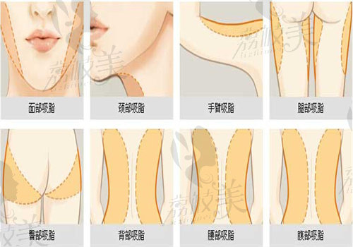 赵希军吸脂的经历和口碑