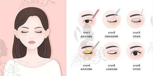 西安米兰柏羽双眼皮多少钱？