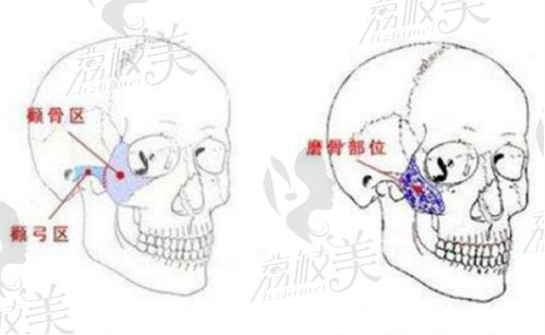 赵延峰做下颌角手术价格