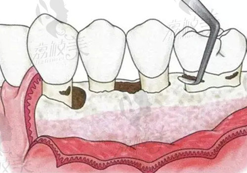 牙周刮治是什么