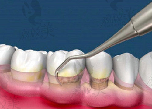 牙周刮治的坏处是什么