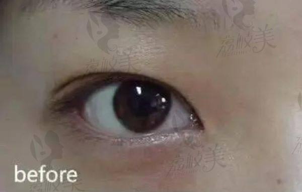 找叶明龙做双眼皮手术前的我