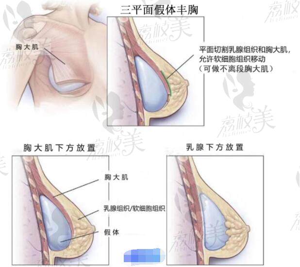 杭州美萊栗勇做假體隆胸好不好