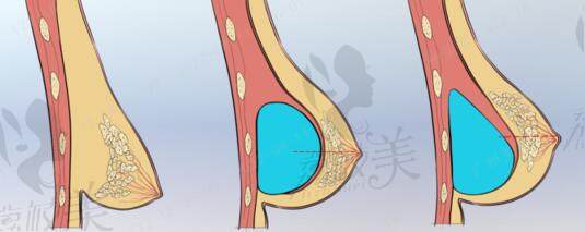 杭州栗勇隆胸技術(shù)好不好