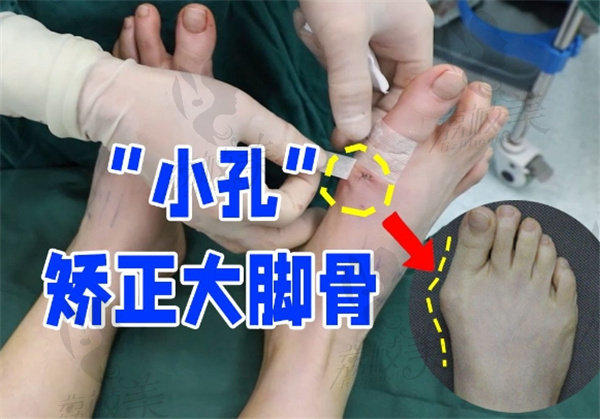 蘇敬達大腳骨手術(shù)要截骨嗎