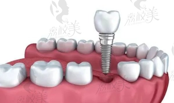 秦皇岛麦格口腔种植牙价格表