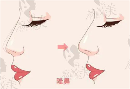 乌鲁木齐王共礼整形隆鼻怎么样？