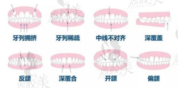 什么样的牙齿需要做矫正