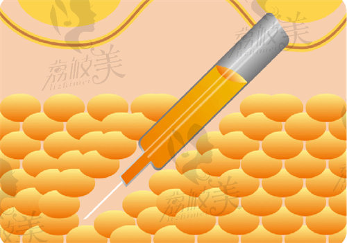 唐新辉医生自体脂肪隆胸价格17600起