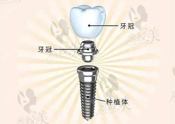 深圳新浩口腔医院种植牙多少钱