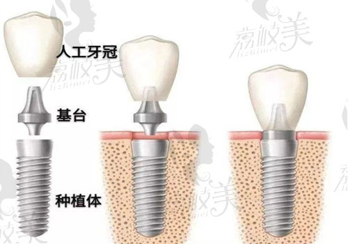 普宁金铂利口腔门诊部种植牙