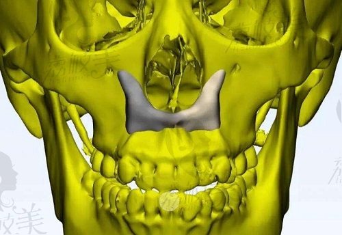 3d人工骨鼻基底