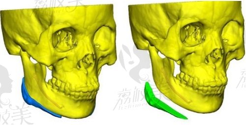 3d人工骨修復下頜骨