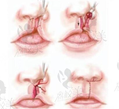 唇裂修复手术