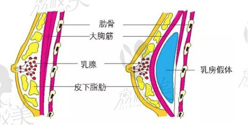 薛瑞隆胸手術(shù)細(xì)節(jié)