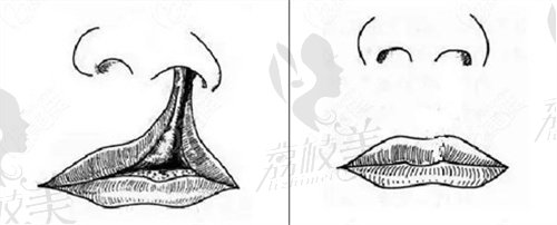 余文林唇裂修復(fù)技術(shù)好不好