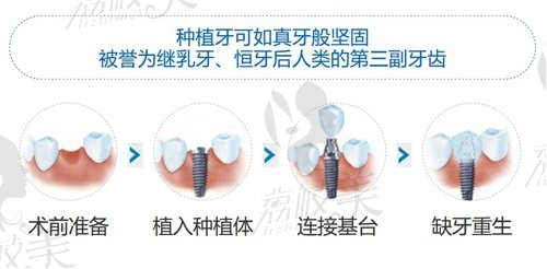 西安中诺口腔医院种植牙过程