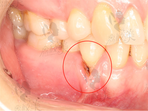 牙龈萎缩了还能种植牙吗