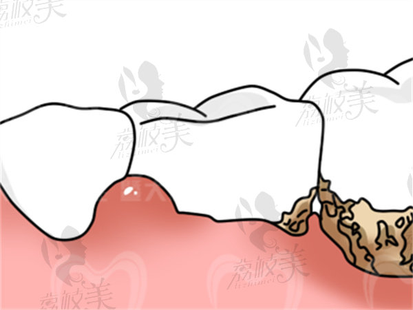 牙龈萎缩了还能种植牙吗