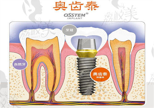 宁波佳兴口腔医院种植牙价格表