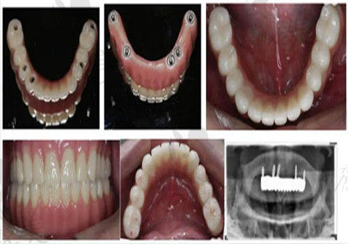 宁波佳兴口腔医院种植牙实例分享
