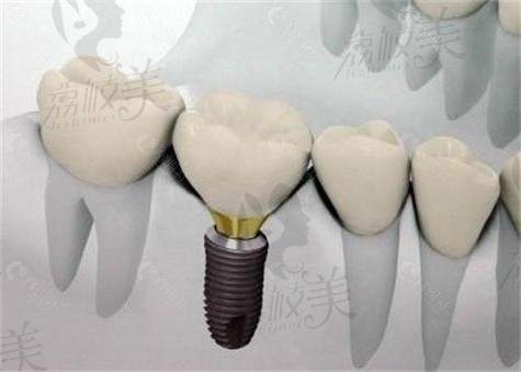 昆明美奥口腔医院做瑞典种植牙多少钱