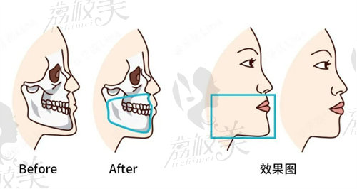 何錦泉正頜優(yōu)勢