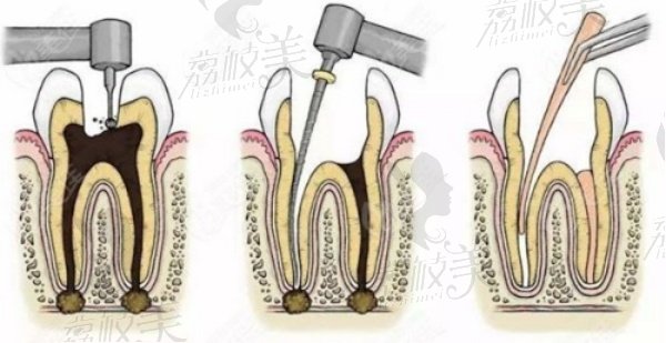 根管治療的具體流程