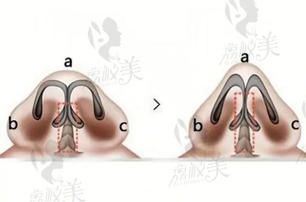 鼻翼缩小手术后需要多久<span style=