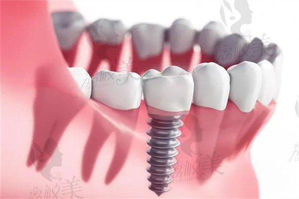 北京极简口腔医院种植牙价格