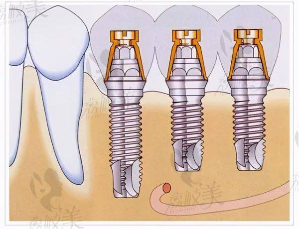 洛阳牙大夫口腔种植牙怎么样