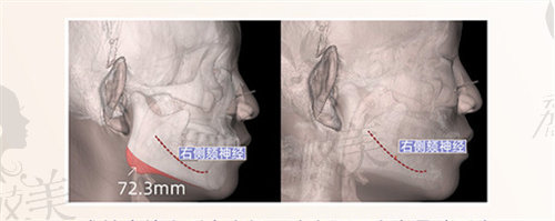 项昌峰磨骨口碑怎么样